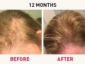 Before and After Photos at 12 Months. Results may vary 